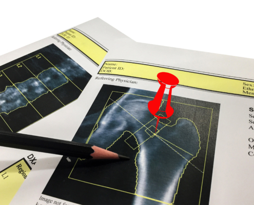 Hip and Spine Bone mineral density (BMD) DEXA densitometry hip scan